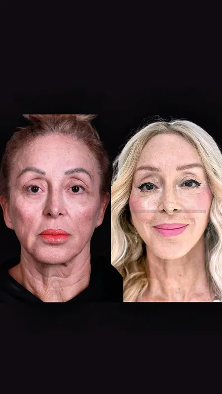 Before and after — Dr. Metin Kerem