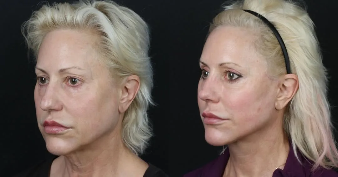 Before and after — Dr. Michael Somenek
