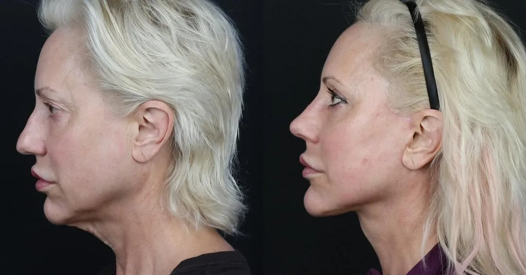 Before and after — Dr. Michael Somenek