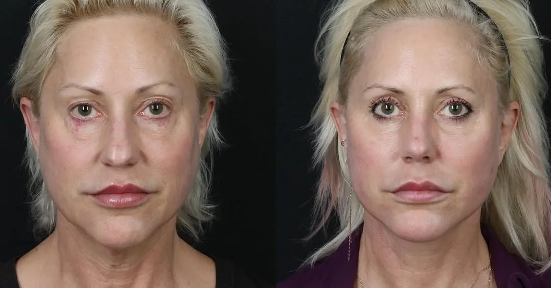 Before and after — Dr. Michael Somenek