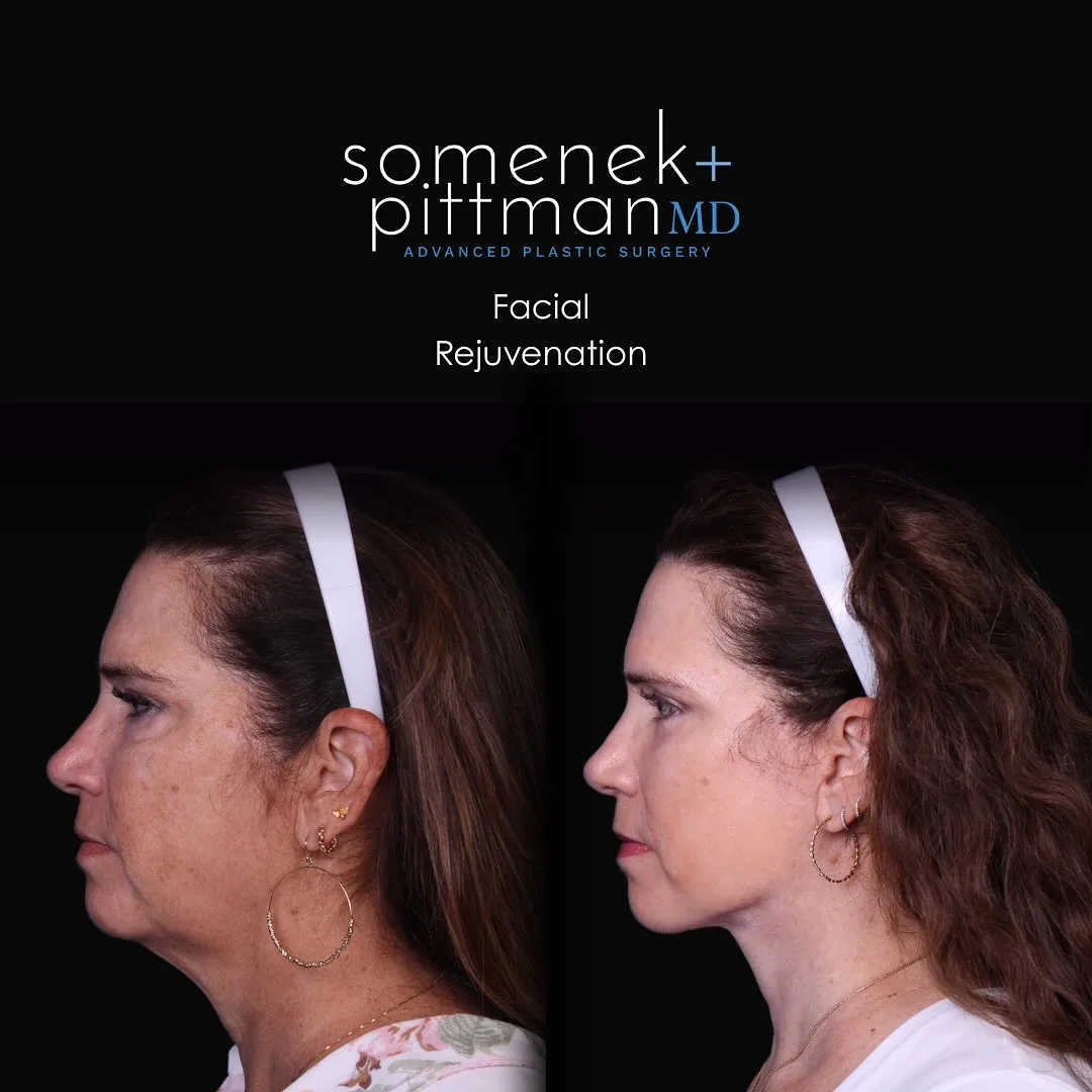 Before and after — Dr. Michael Somenek