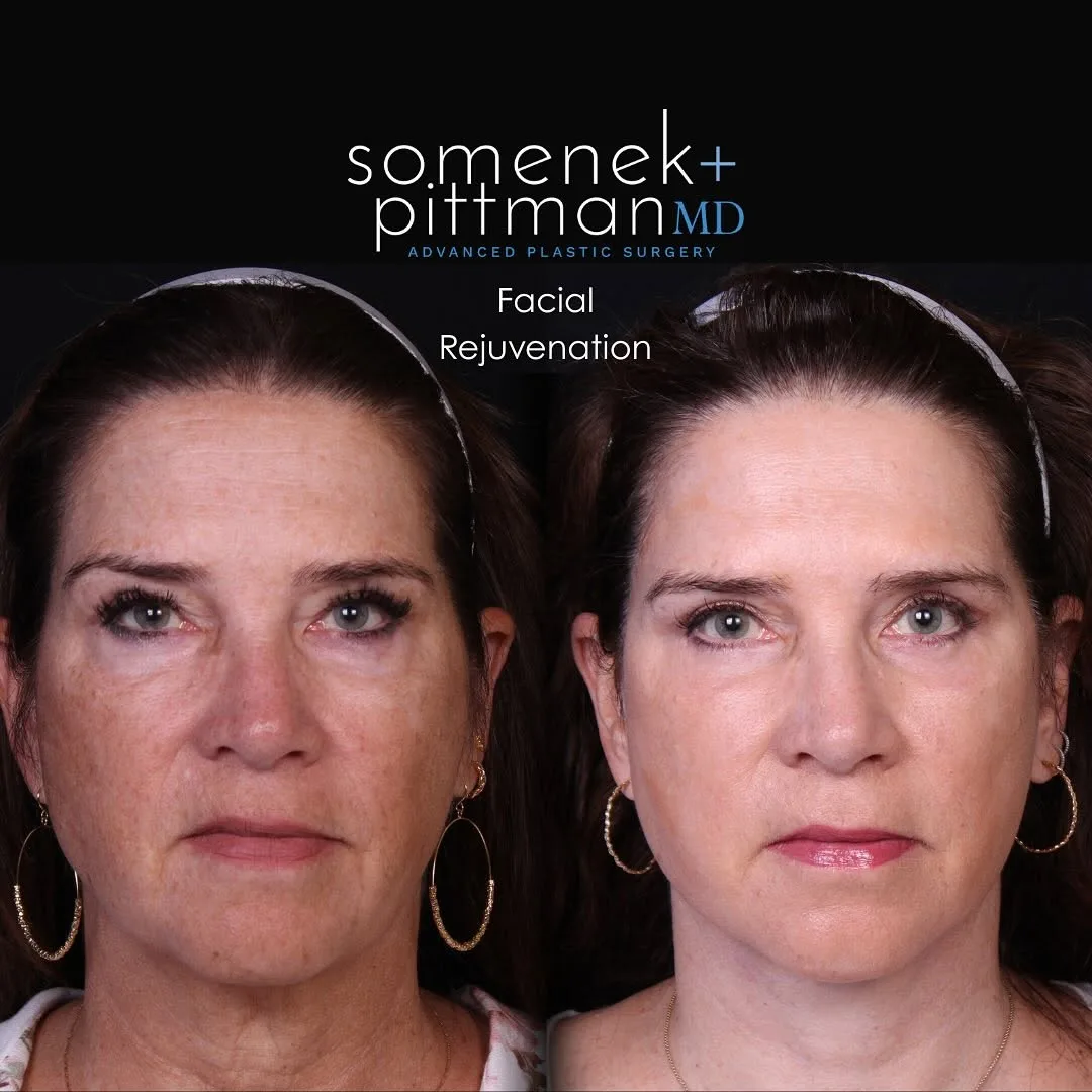 Before and after — Dr. Michael Somenek