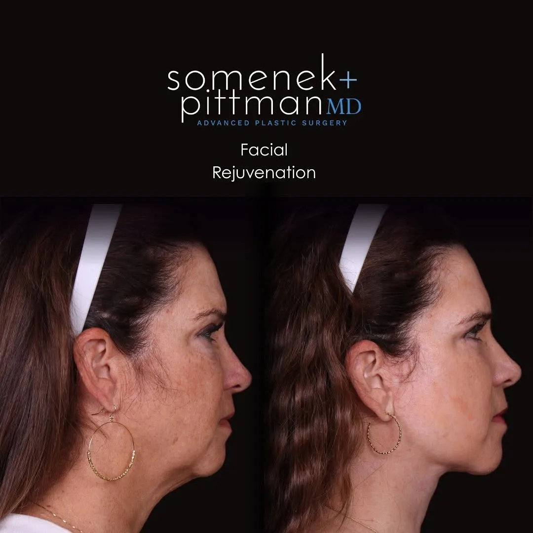 Before and after — Dr. Michael Somenek