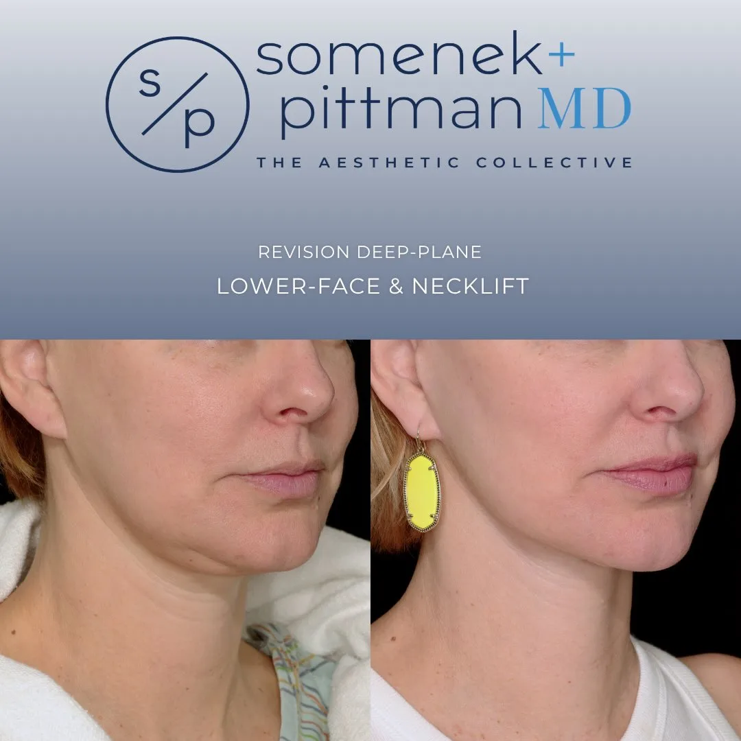 Before and after — Dr. Michael Somenek