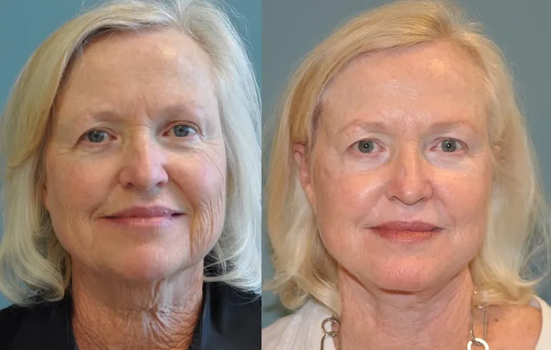 Before and after deep plane facelift — -1-year-old patient, frontal view by Dr. Michael Sundine