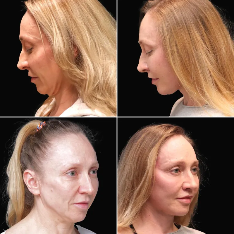 Before and after — Dr. Michał Charytonowicz