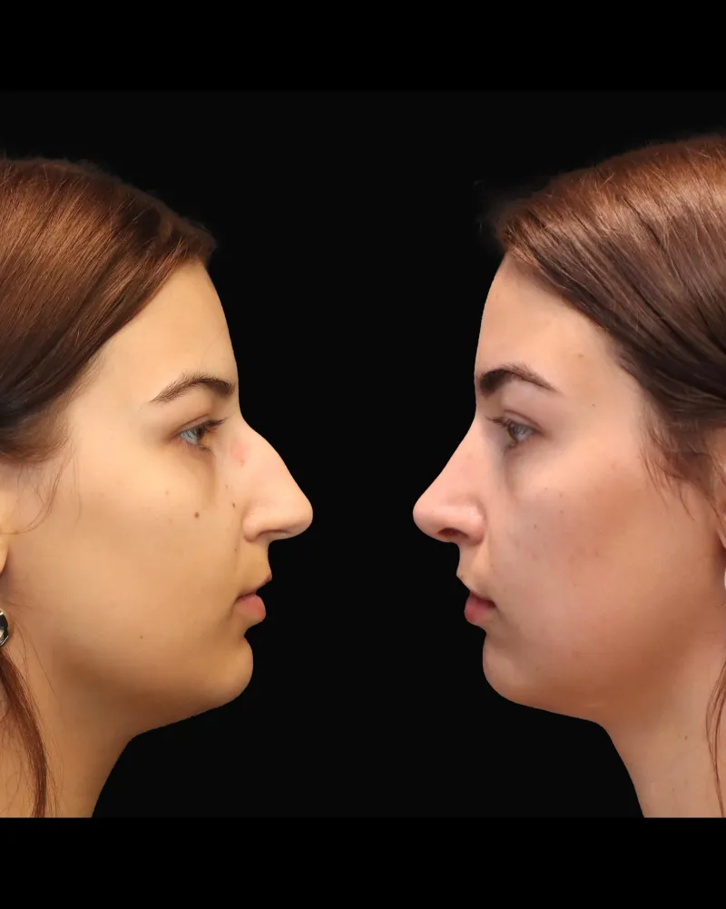 Before and after — Dr. Michał Charytonowicz