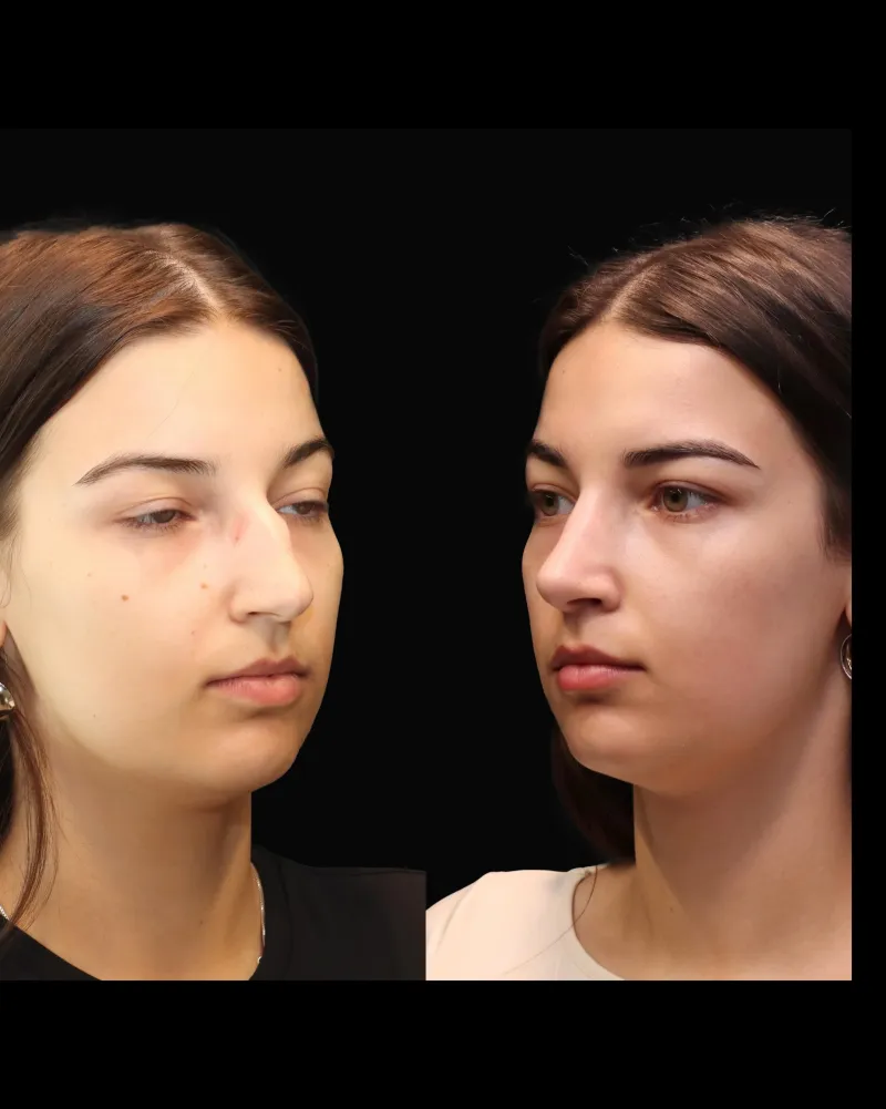 Before and after — Dr. Michał Charytonowicz