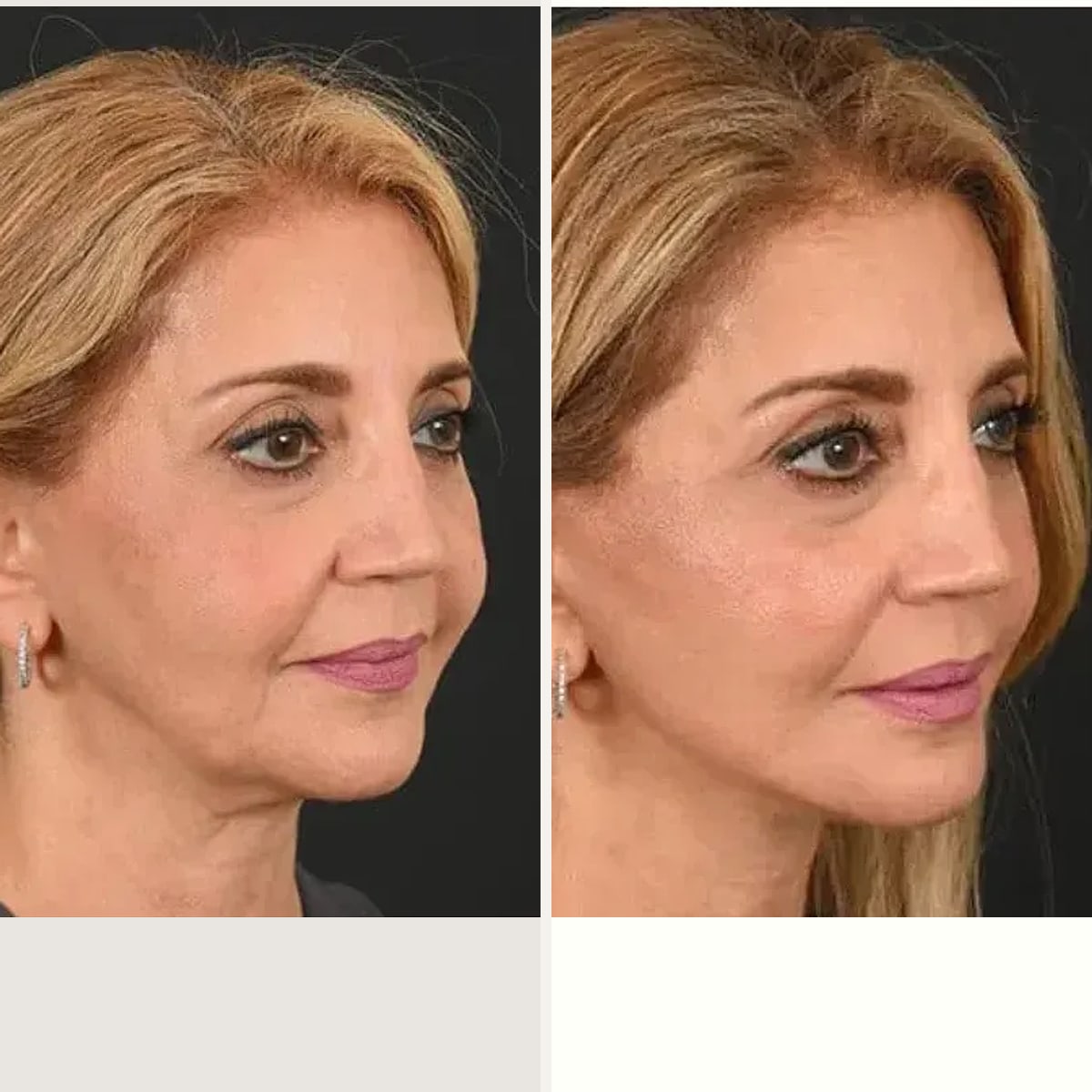 Before and after: Dr. Michel Siegel