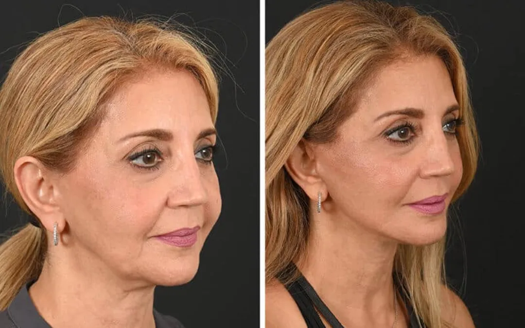 Before and after deep plane facelift — 52-year-old woman, oblique right view, 8mo post-op by Dr. Michel Siegel