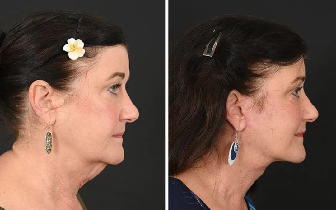 Before and after deep plane facelift — 55-year-old woman, right profile view, 6mo post-op by Dr. Michel Siegel