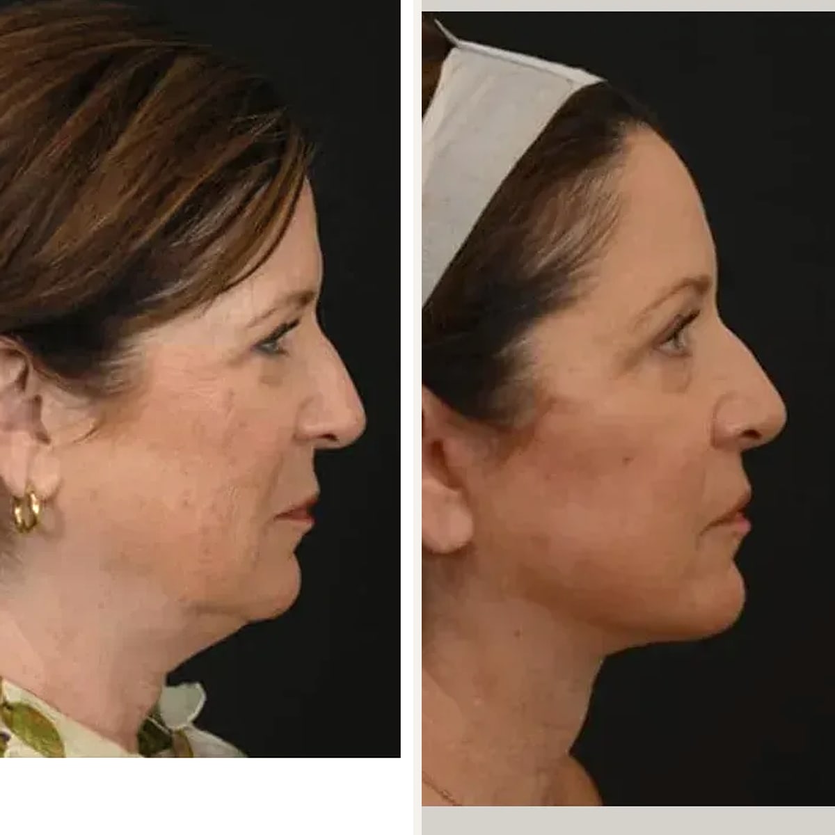 Before and after: Dr. Michel Siegel