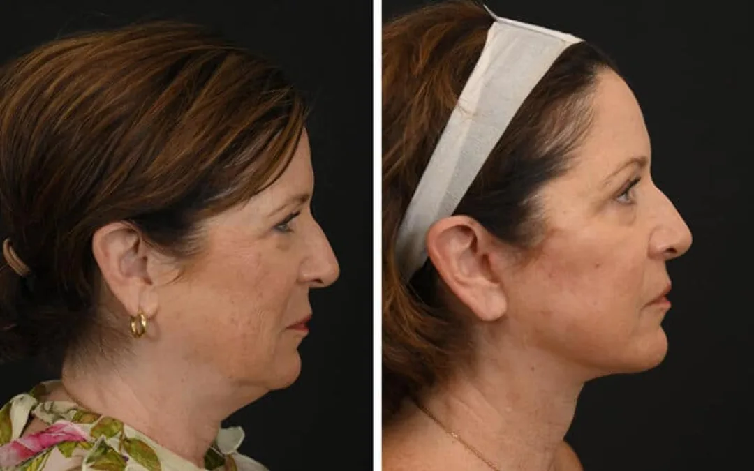 Before and after deep plane facelift — 52-year-old woman, right profile view, 6mo post-op by Dr. Michel Siegel