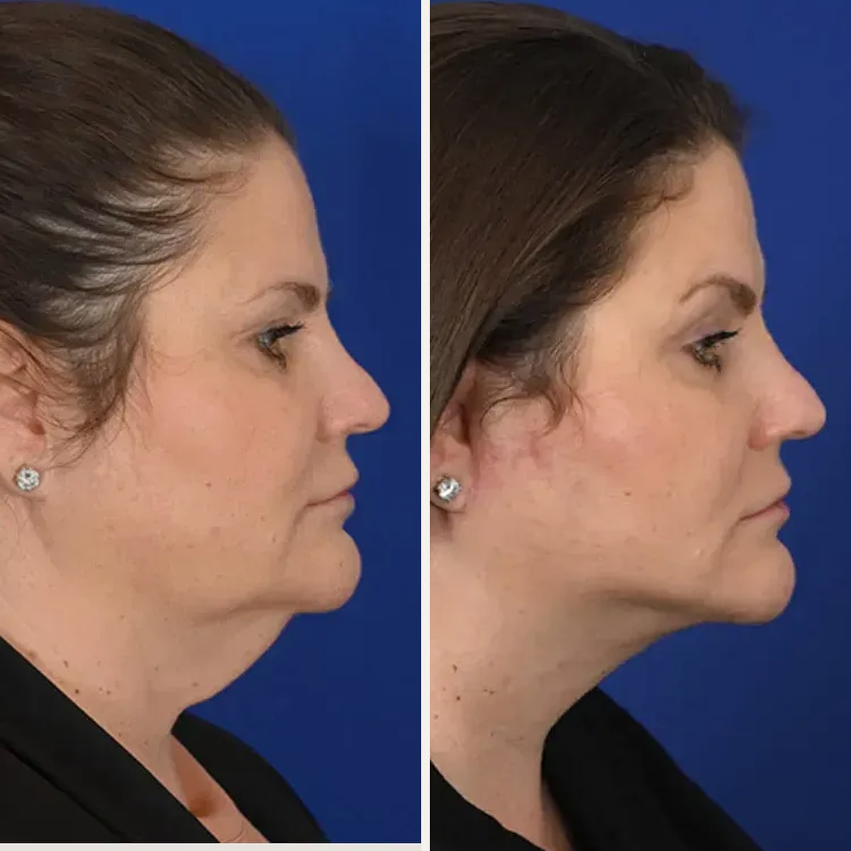 Before and after: Dr. Michel Siegel