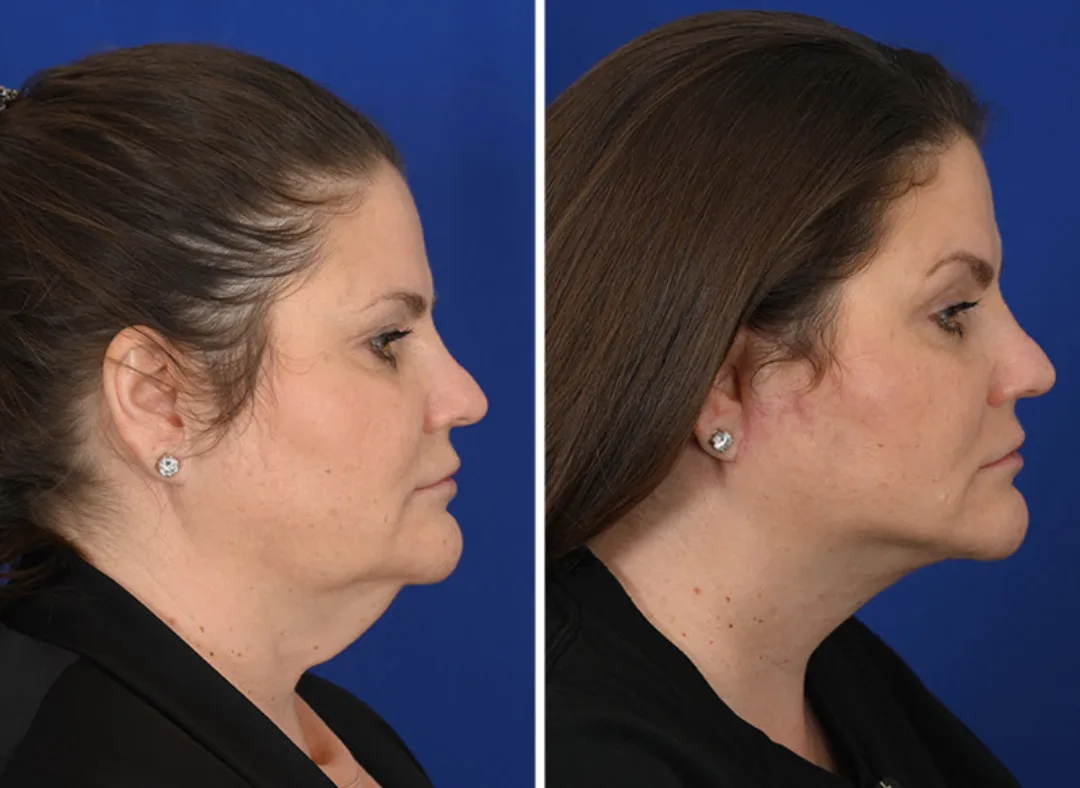 Before and after deep plane facelift — 48-year-old woman, right profile view, 7mo post-op by Dr. Michel Siegel