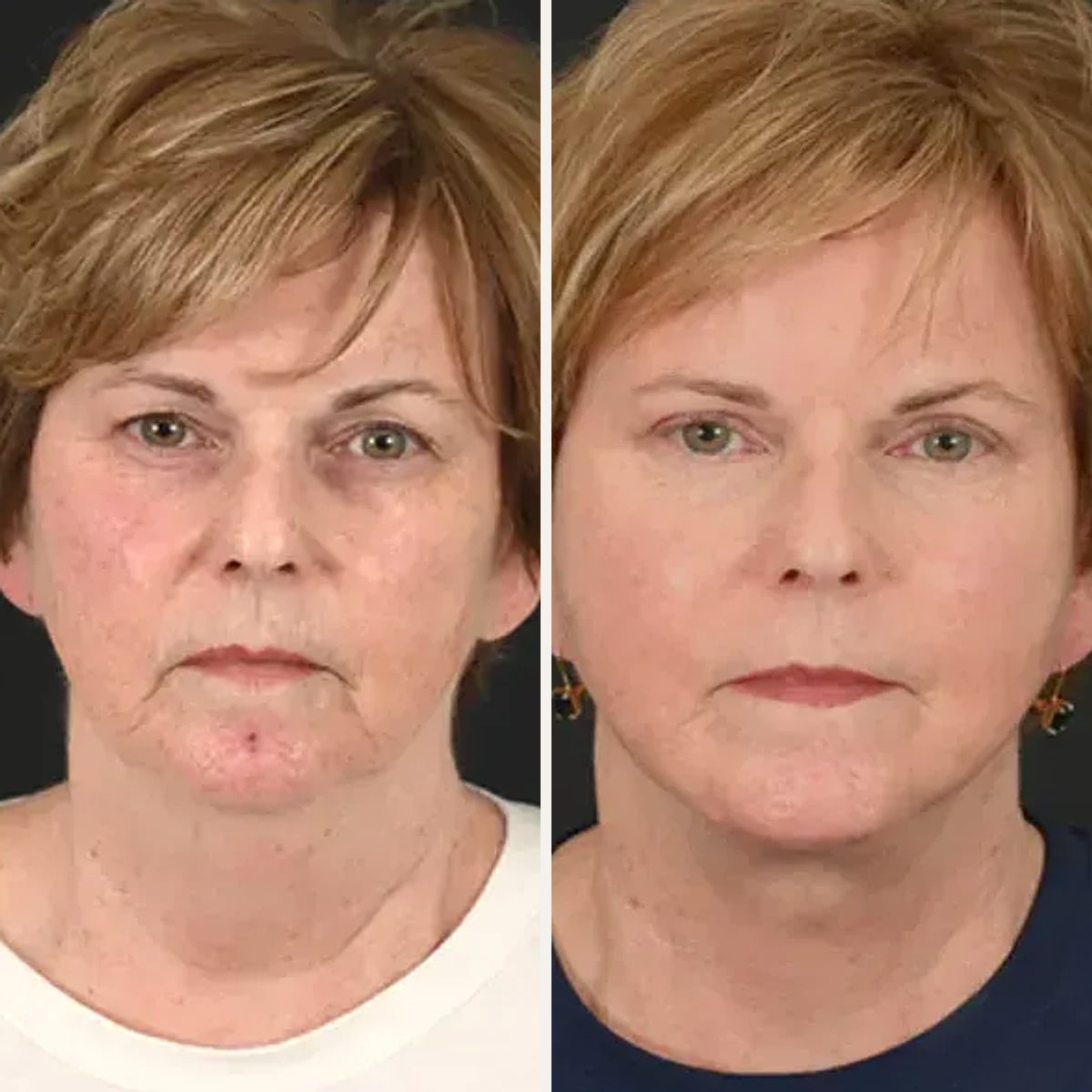 Before and after: Dr. Michel Siegel