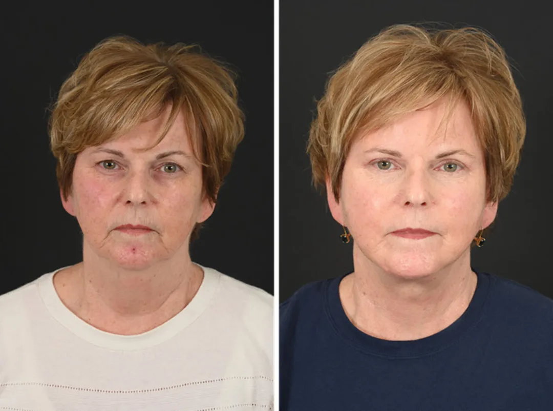 Before and after deep plane facelift — 55-year-old woman, frontal view, 7mo post-op by Dr. Michel Siegel