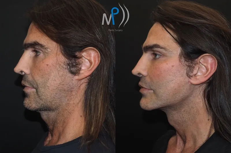 Before and after — Dr. Michele Pascali
