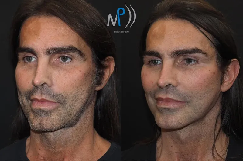 Before and after — Dr. Michele Pascali