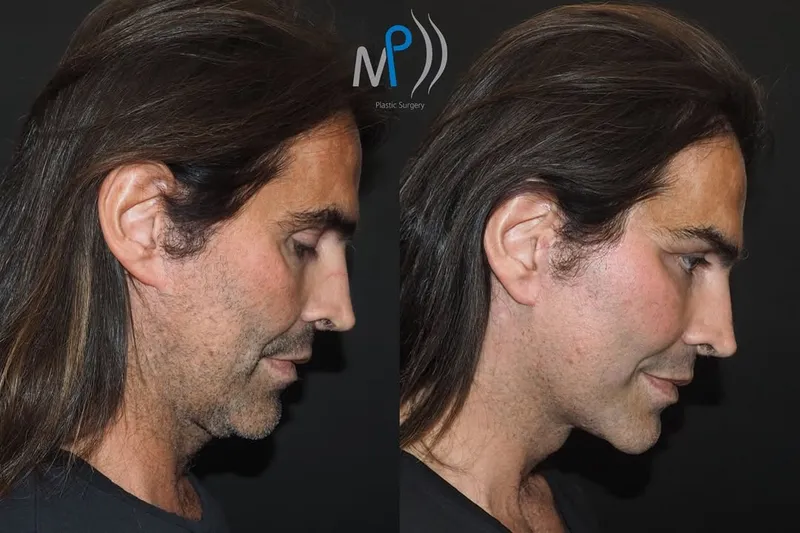 Before and after — Dr. Michele Pascali