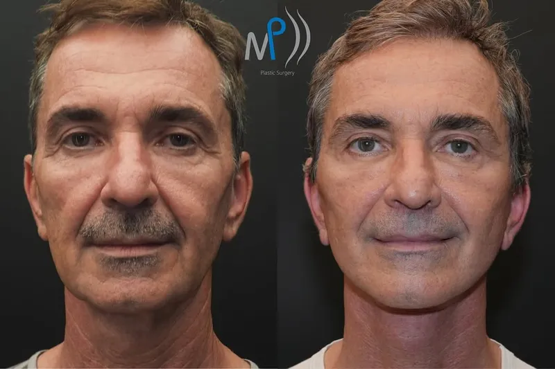 Before and after — Dr. Michele Pascali
