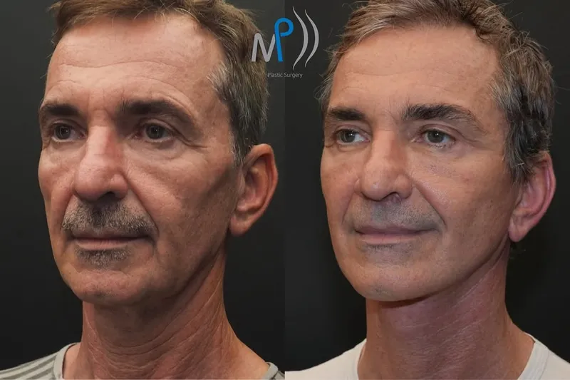 Before and after — Dr. Michele Pascali