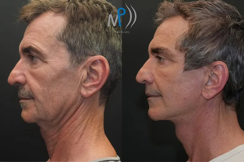Before and after — Dr. Michele Pascali