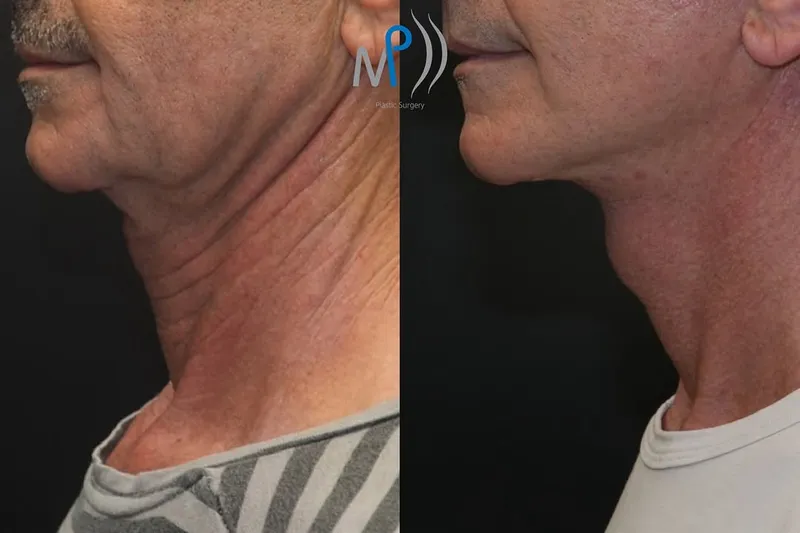 Before and after — Dr. Michele Pascali
