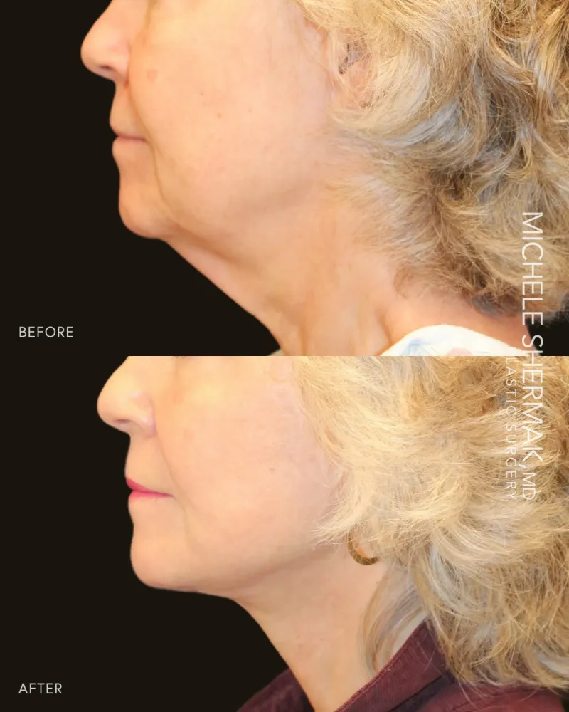Before and after: Dr. Michele Shermak