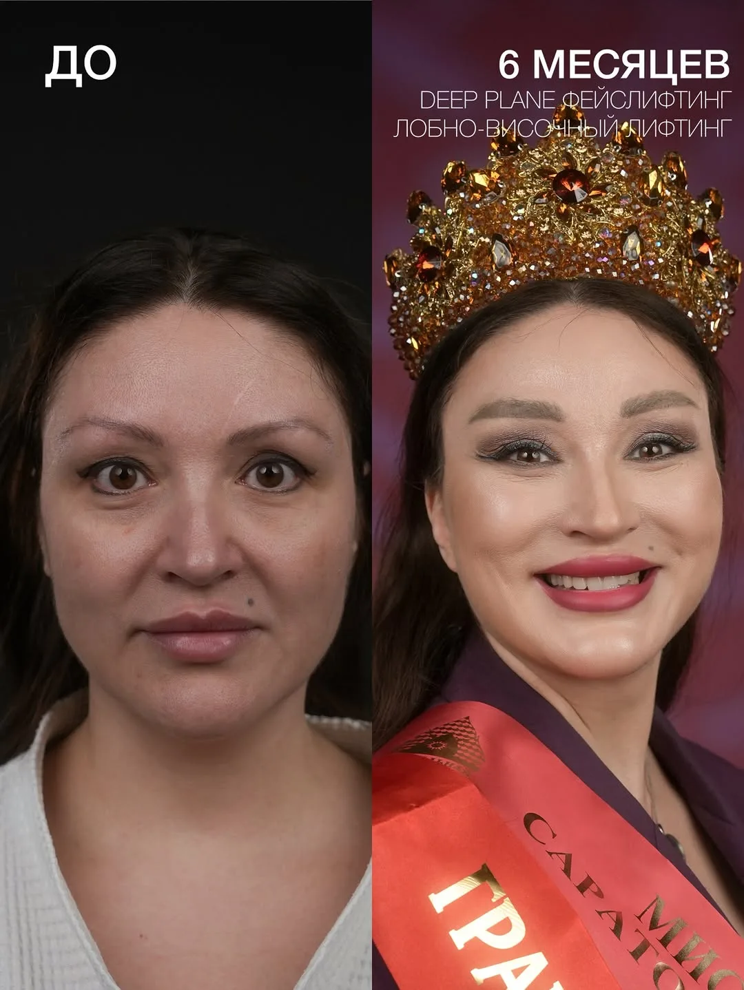 Before and after deep plane facelift — 45-year-old woman, frontal view, 6mo post-op by Dr. Mihail Frolov