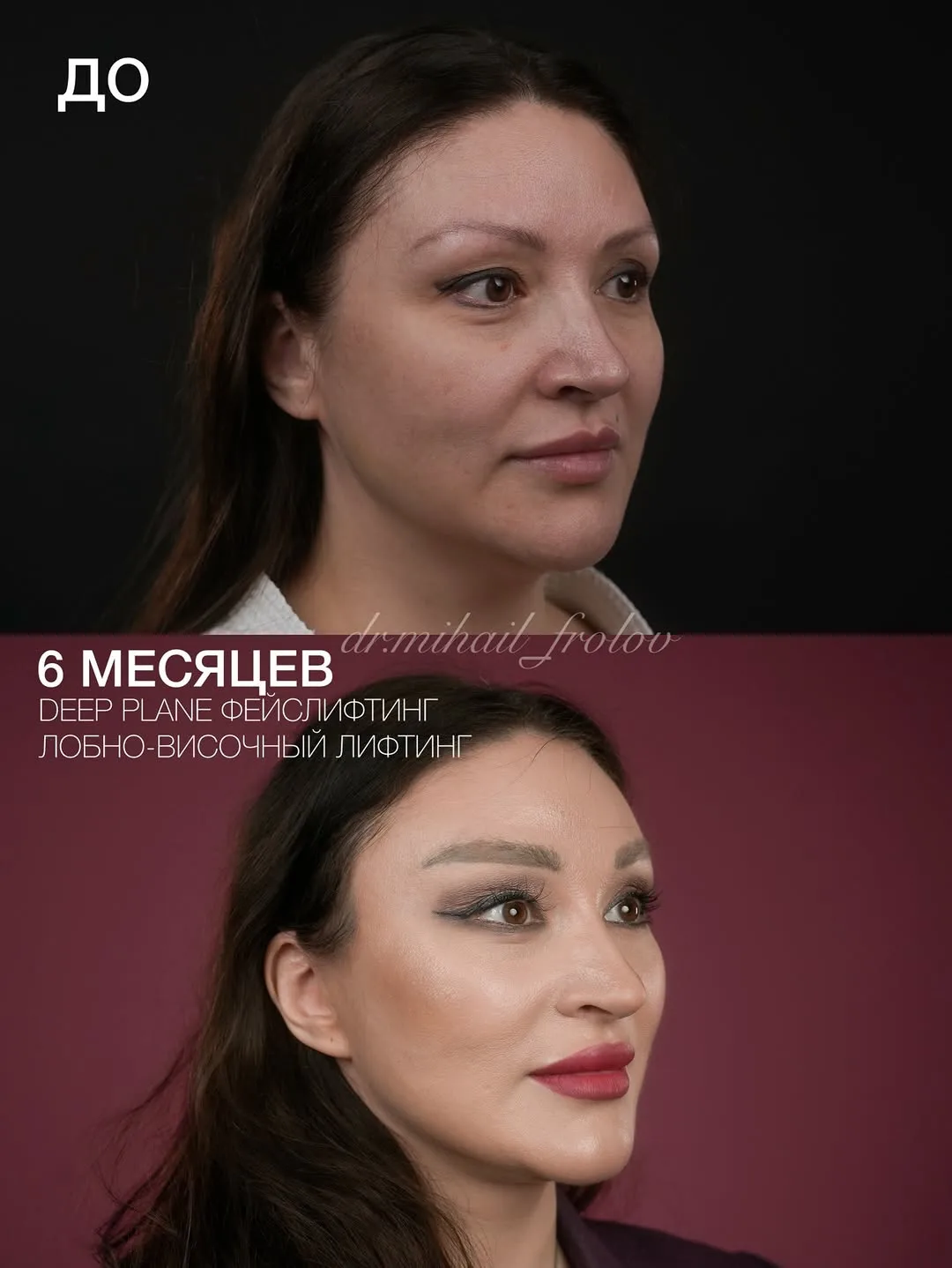 Before and after deep plane facelift — 45-year-old woman, oblique right view, 6mo post-op by Dr. Mihail Frolov