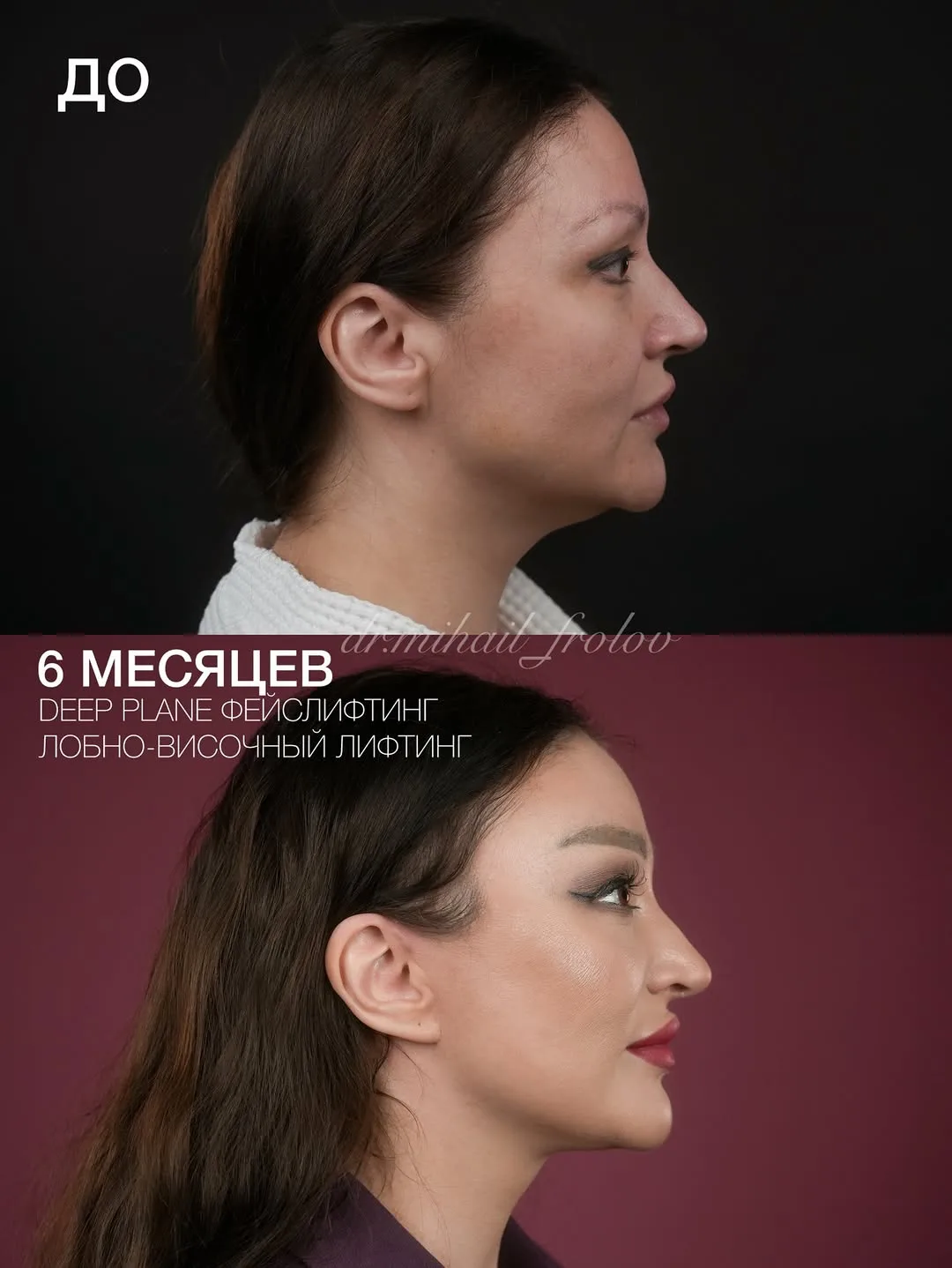 Before and after deep plane facelift — 42-year-old woman, right profile view, 6mo post-op by Dr. Mihail Frolov