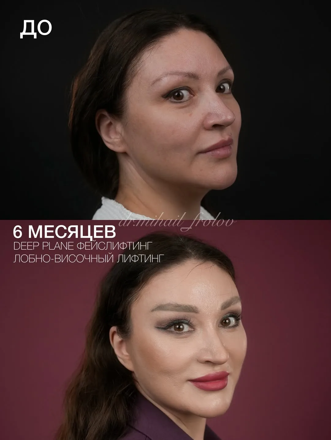 Before and after deep plane facelift — 45-year-old woman, three-quarter view, 6mo post-op by Dr. Mihail Frolov