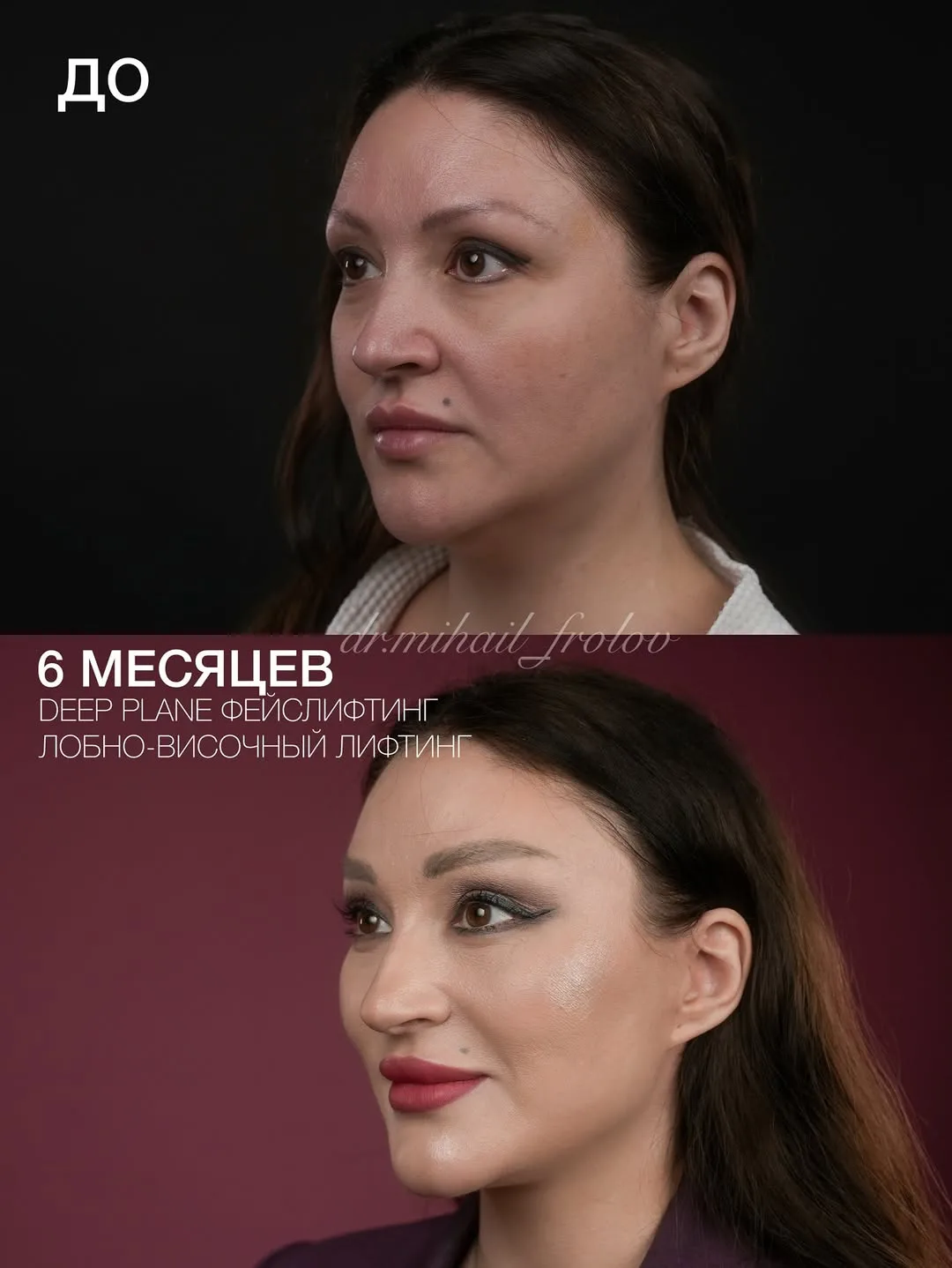 Before and after deep plane facelift — 45-year-old woman, oblique right view, 6mo post-op by Dr. Mihail Frolov