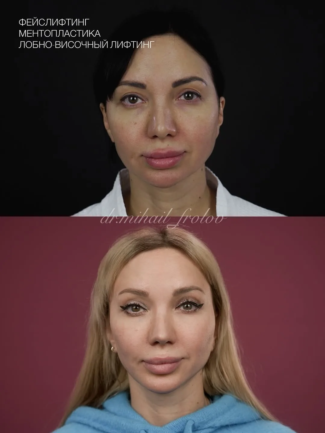 Before and after deep plane facelift — 42-year-old woman, frontal view, 7mo post-op by Dr. Mihail Frolov