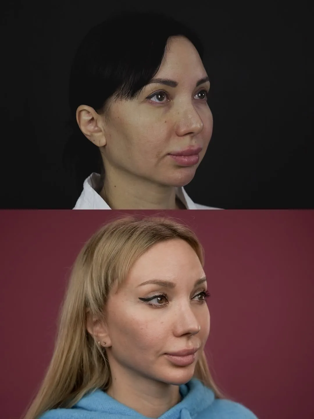 Before and after deep plane facelift — 38-year-old woman, oblique right view, 6mo post-op by Dr. Mihail Frolov