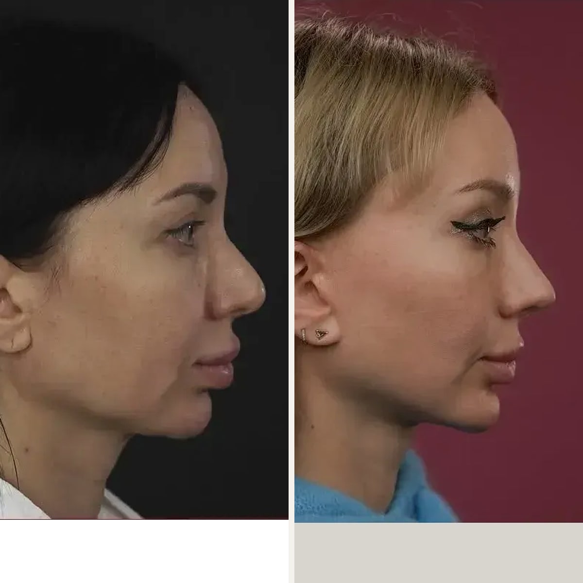 Before and after, Deep Plane Facelift