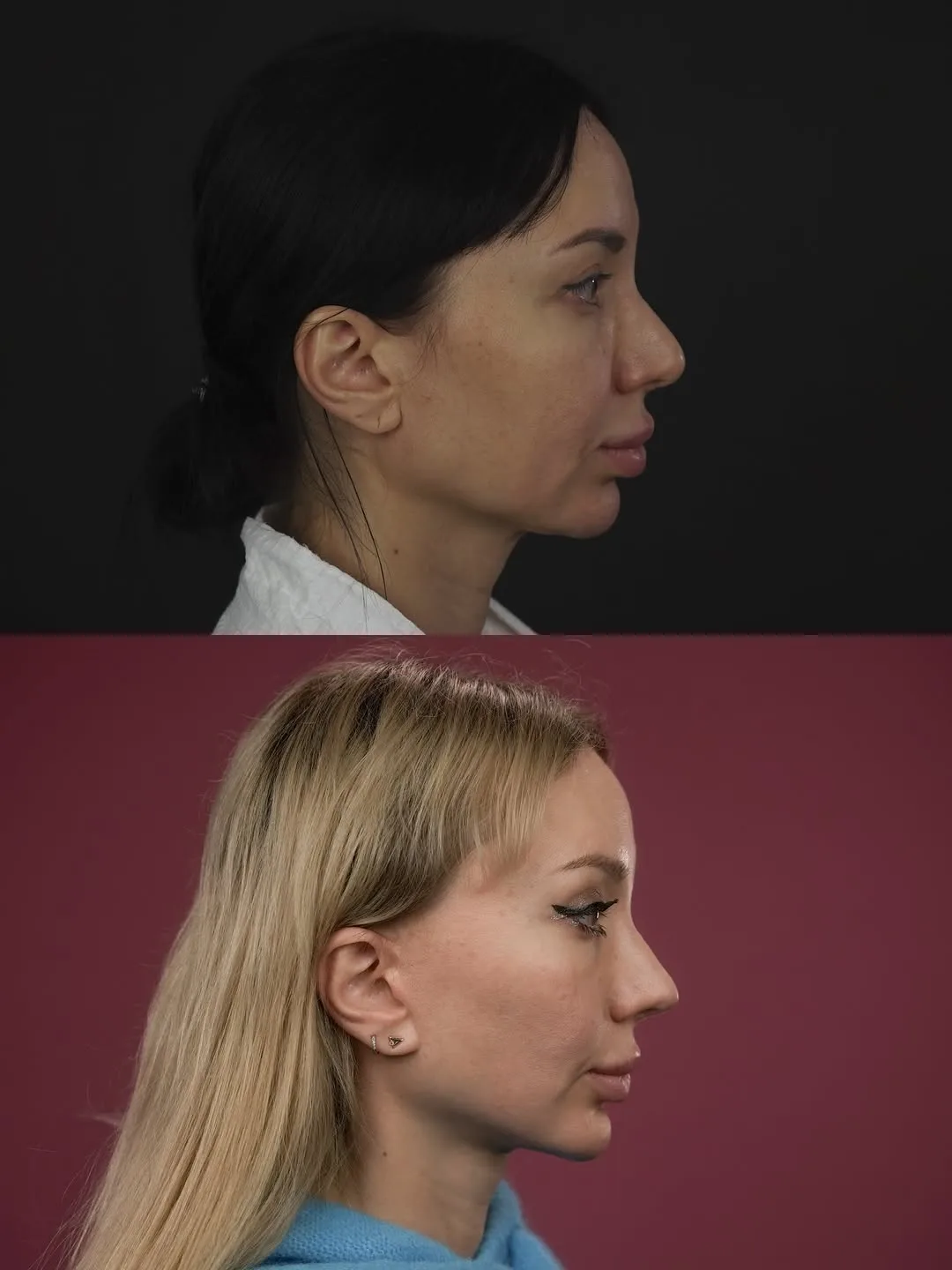 Before and after deep plane facelift — 28-year-old woman, left profile view, 7mo post-op by Dr. Mihail Frolov