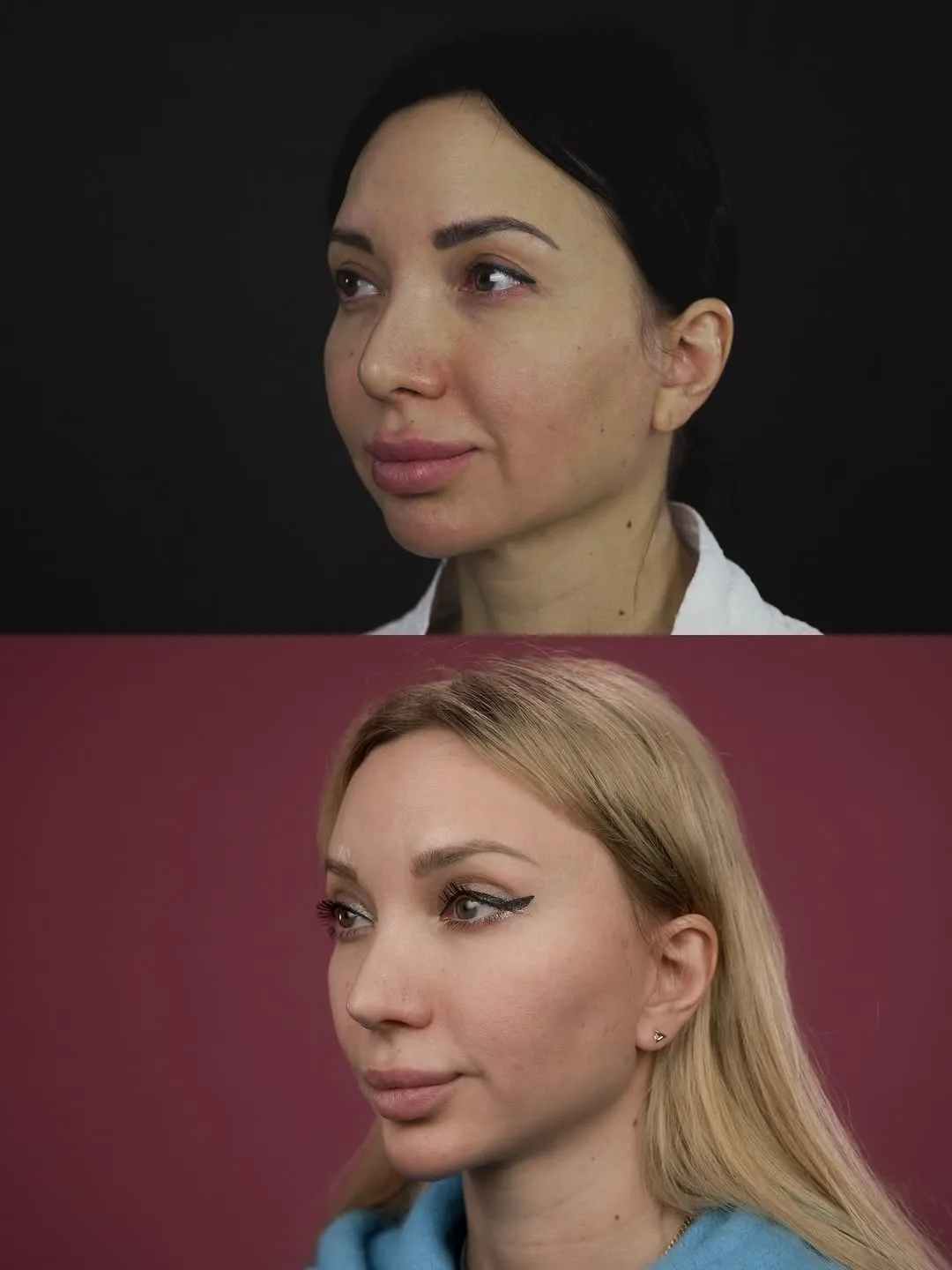 Before and after deep plane facelift — 35-year-old woman, oblique right view, 6mo post-op by Dr. Mihail Frolov