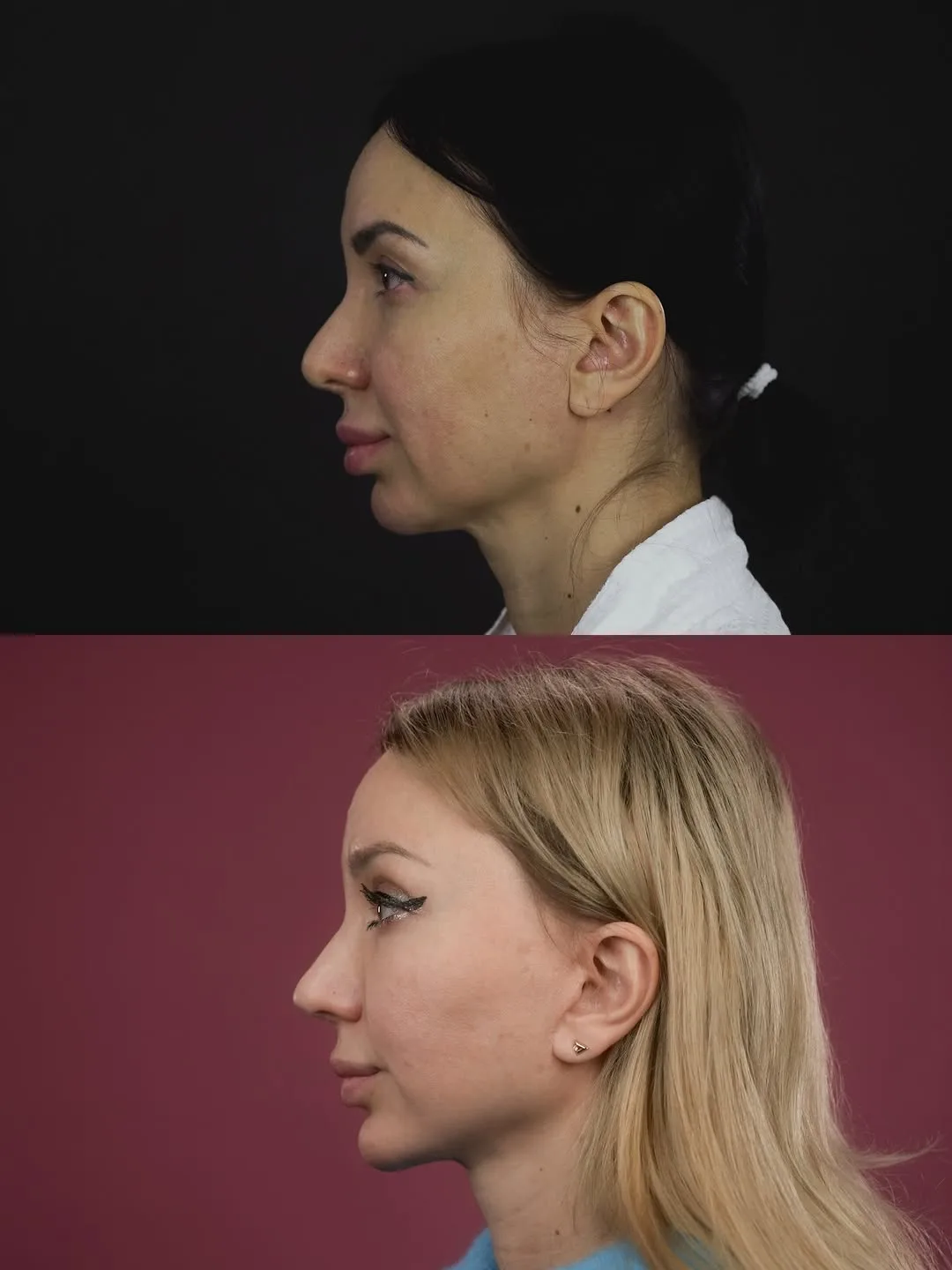 Before and after deep plane facelift — 28-year-old woman, left profile view, 9mo post-op by Dr. Mihail Frolov