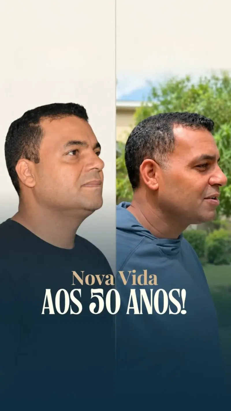 قبل وبعد - Deep Plane Facelift بواسطة د. Milton Hayashi