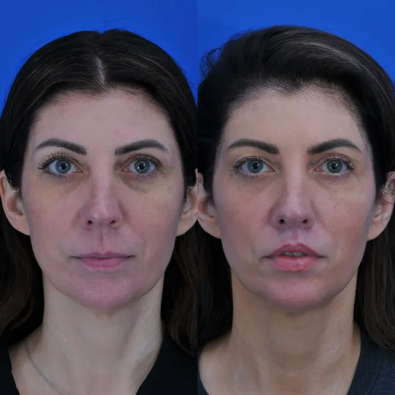 Before and after — Dr. Minas Constantinides
