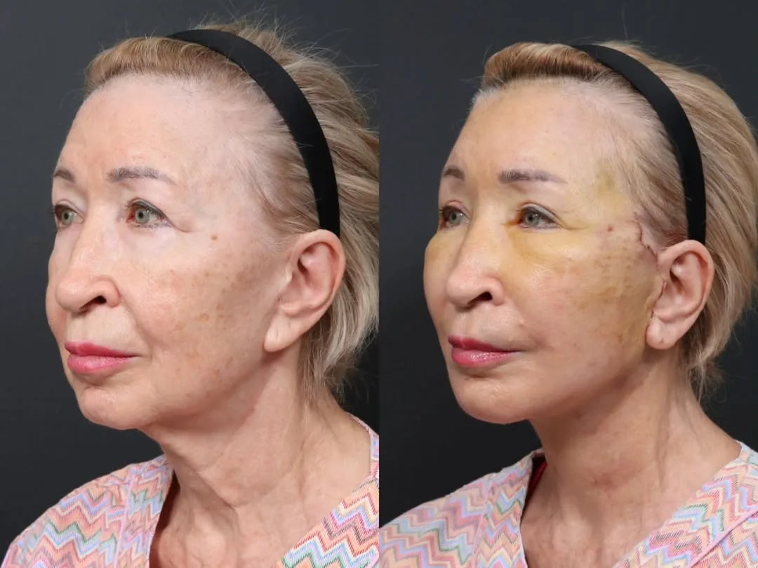 Before and after — Dr. Minhee Ryu
