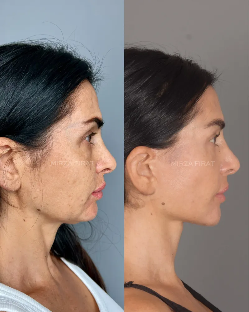 Before and after deep plane facelift, frontal view by Dr. Mirza Fırat