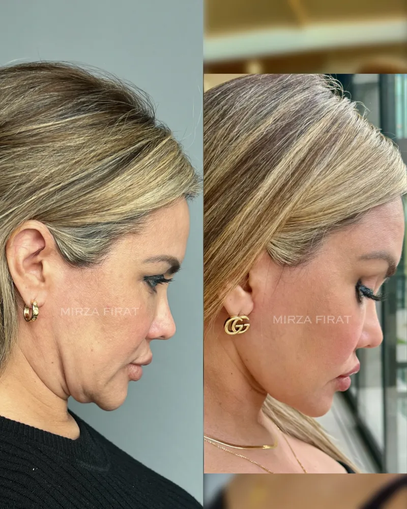 Before and after deep plane facelift, frontal view by Dr. Mirza Fırat
