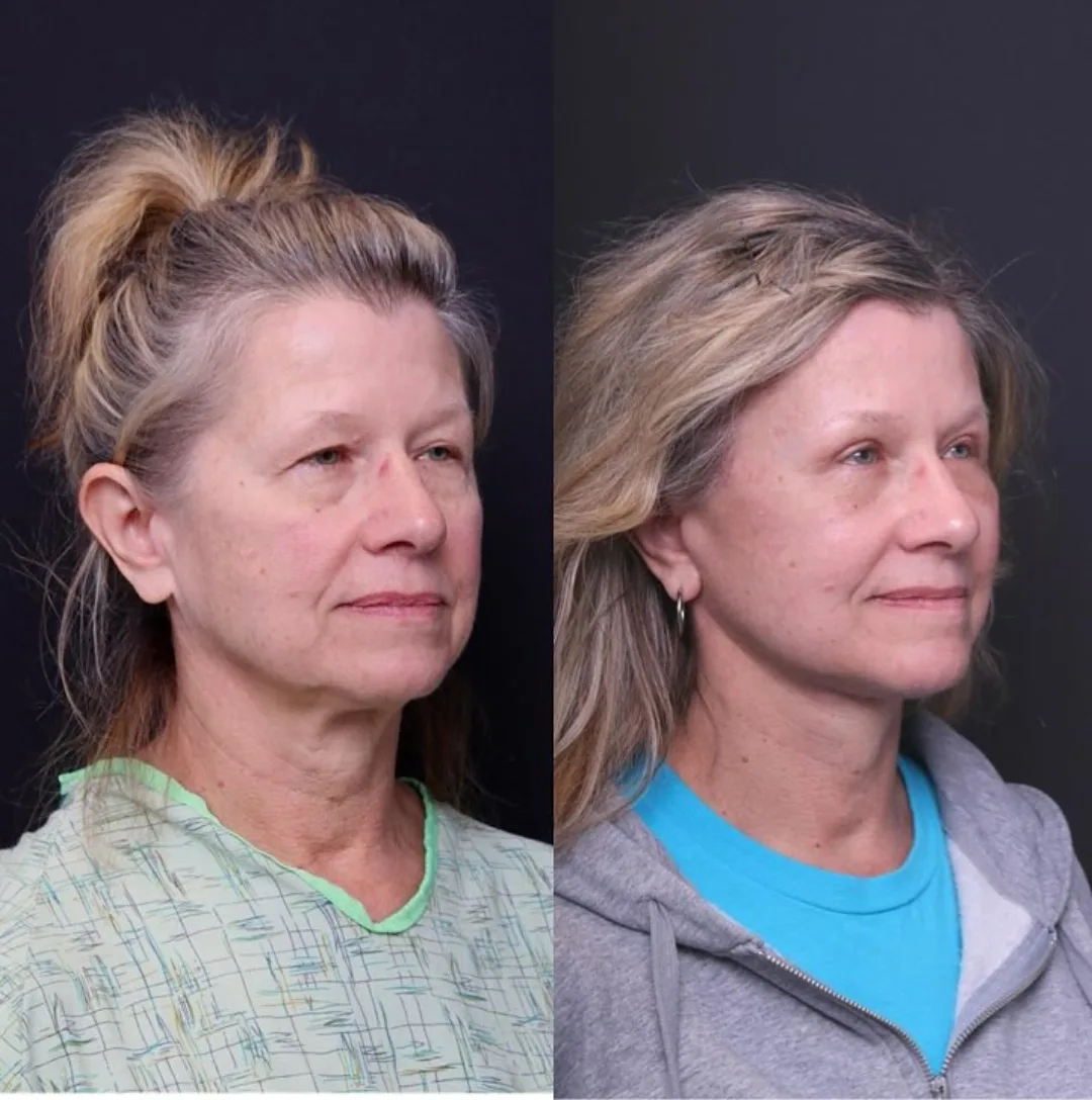 Before and after — Dr. Mitchell Hagen