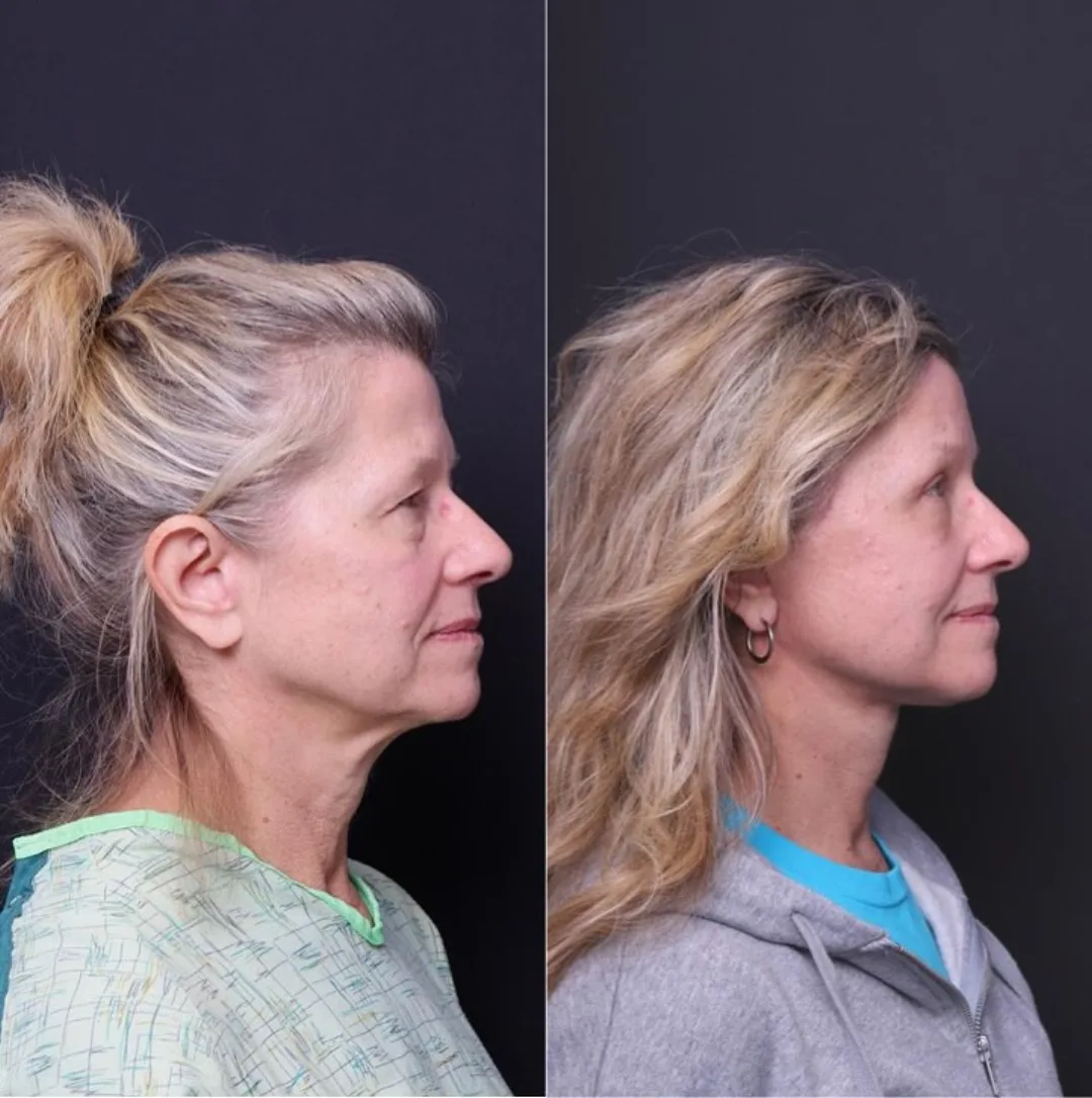 Before and after — Dr. Mitchell Hagen