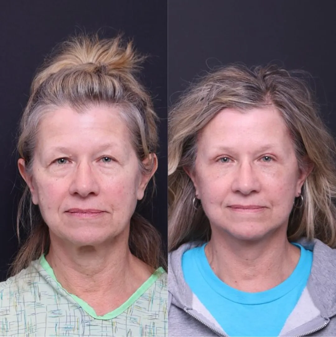 Before and after — Dr. Mitchell Hagen