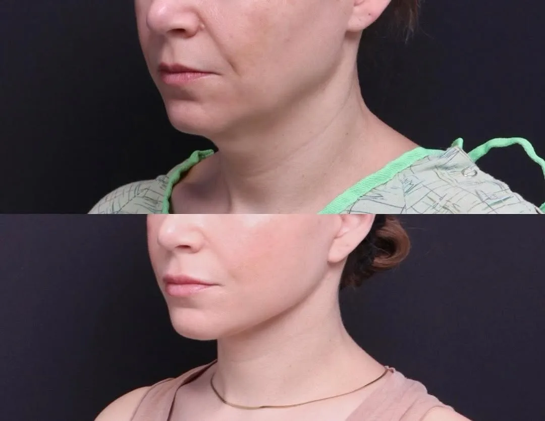 Before and after — Dr. Mitchell Hagen