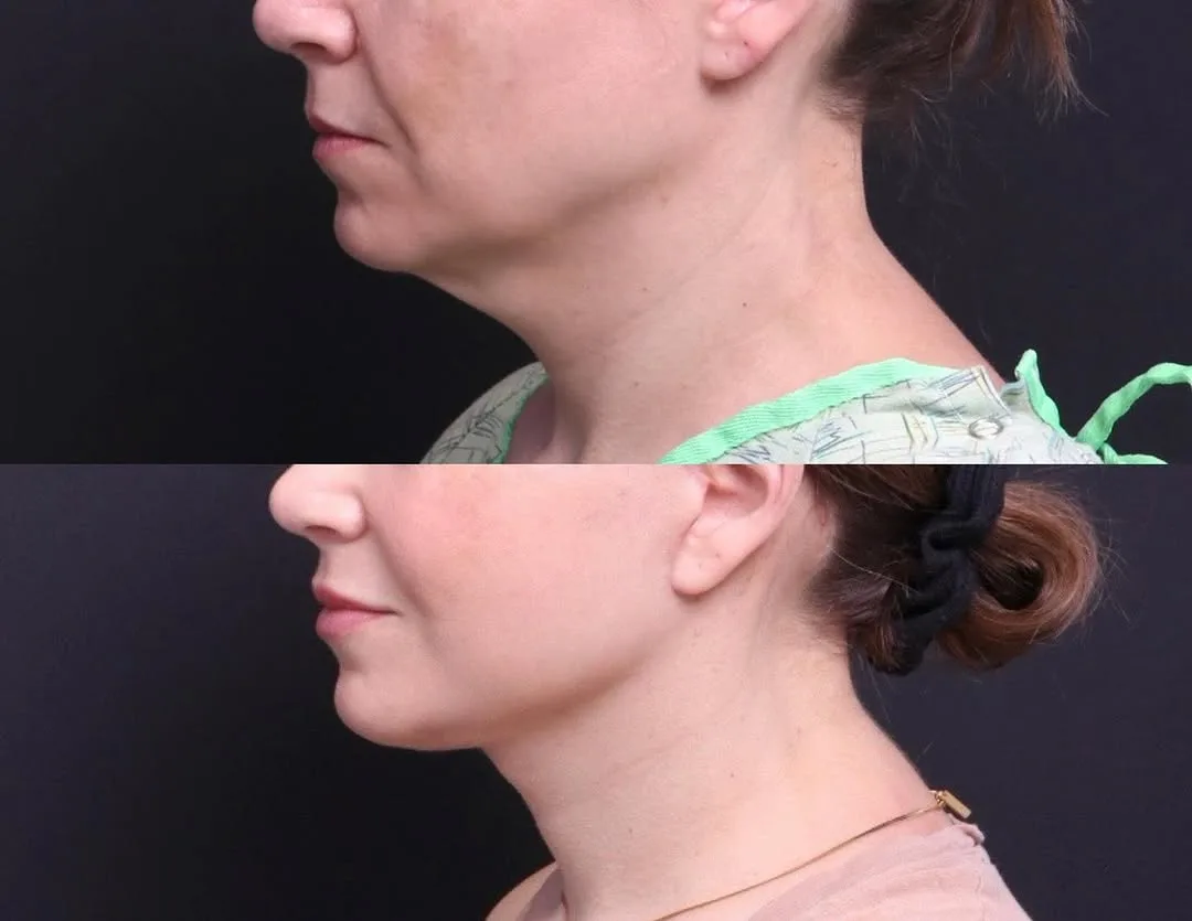 Before and after — Dr. Mitchell Hagen